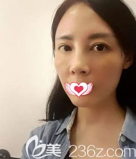 巧致院長王立英做脂肪填充面部7天面部消腫 巧致院長王立英做脂肪填充面部7天面部消腫