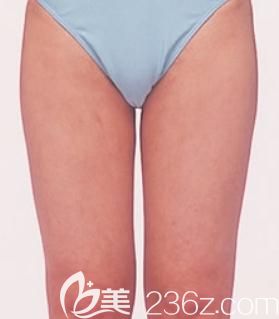 在日本東京青山賽儷絲醫(yī)院找元神賢太給我做了大腿吸脂，擺脫大象腿