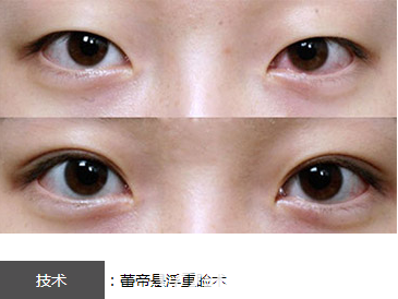 宜昌蕾帝整形醫(yī)院懸浮重瞼術(shù)雙眼皮效果圖 宜昌蕾帝整形醫(yī)院懸浮重瞼術(shù)雙眼皮效果圖