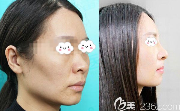 宜昌蕾帝整形醫(yī)院鼻綜合隆鼻案例效果對比圖 宜昌蕾帝整形醫(yī)院鼻綜合隆鼻案例效果對比圖