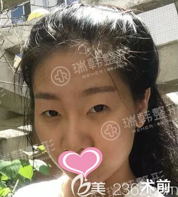 自體脂肪填充面部+蘿莉大眼術(shù)前照 自體脂肪填充面部+蘿莉大眼術(shù)前照