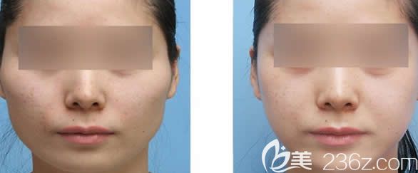 玉林時(shí)光整形<!--<i data=20240703-sp></i>-->生顴弓降低案例效果圖 玉林時(shí)光整形<!--<i data=20240703-sp></i>-->生顴弓降低案例效果圖