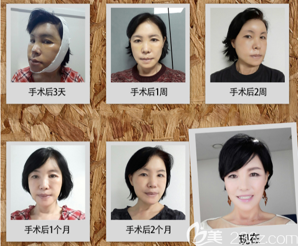 宋志英術(shù)后3個月的恢復(fù)過程 宋志英術(shù)后3個月的恢復(fù)過程