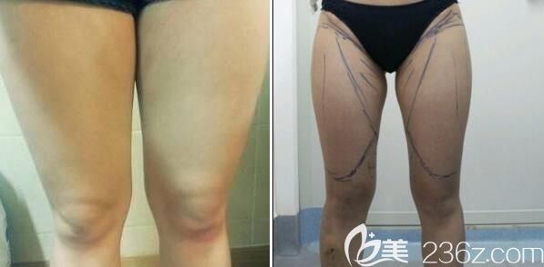 四川友誼醫(yī)院馬懿術(shù)前照片1