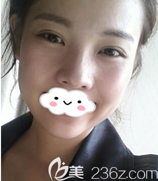 術(shù)后兩個月