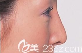 誰來拯救我的鷹鉤鼻?說說我去京青山賽儷絲醫(yī)院找柴田健了醫(yī)生做鷹鉤鼻矯正的全過程