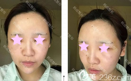 南寧韓成高靜給我做自體脂肪填充全臉術(shù)后第2天 南寧韓成高靜給我做自體脂肪填充全臉術(shù)后第2天