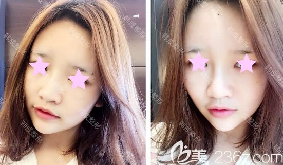 我在南寧韓成整形做全臉自體脂肪填充第5天照片 我在南寧韓成整形做全臉自體脂肪填充第5天照片