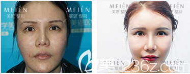 廣州美恩許揚(yáng)濱隆鼻失敗修復(fù)案例 廣州美恩許揚(yáng)濱隆鼻失敗修復(fù)案例