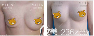 廣州美恩許揚(yáng)濱做的奧美定取出真人案例 廣州美恩許揚(yáng)濱做的奧美定取出真人案例