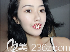 劉彥龍做雙眼皮怎么樣