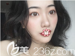 重慶藝星整形做雙眼皮怎么樣