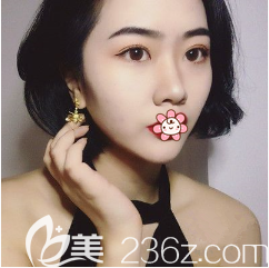 重慶藝星整形雙眼皮加自體脂肪面部填充術(shù)后2個(gè)月