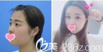 醫(yī)院整形美容科孫宇眼綜合真人案例 醫(yī)院整形美容科孫宇眼綜合真人案例