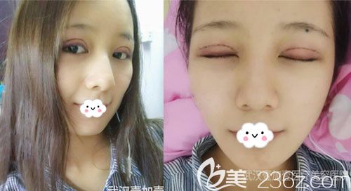 武漢壹加壹付俊俐雙眼皮修復(fù)術(shù)后疤痕效果