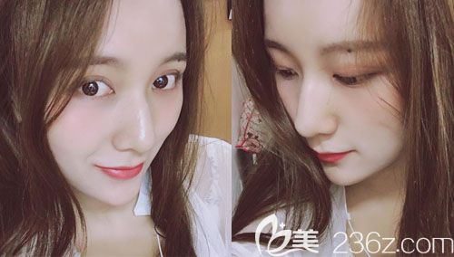 武漢壹加壹付俊俐雙眼皮失敗修復(fù)案例術(shù)后恢復(fù)圖片