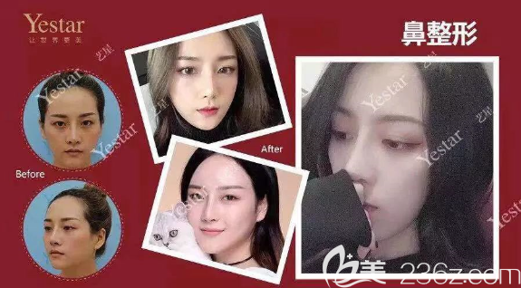 重慶藝星整形隆鼻好不好