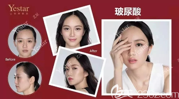 重慶藝星整形玻尿酸隆鼻怎么樣