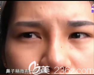 鼻部歪斜狀態(tài)