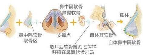 鼻綜合手術(shù)示意圖