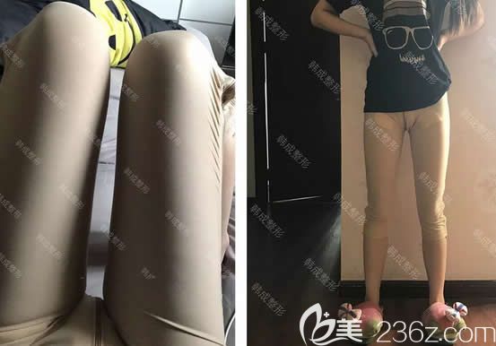 我在南寧韓成整形做大腿360環(huán)吸第3天 我在南寧韓成整形做大腿360環(huán)吸第3天