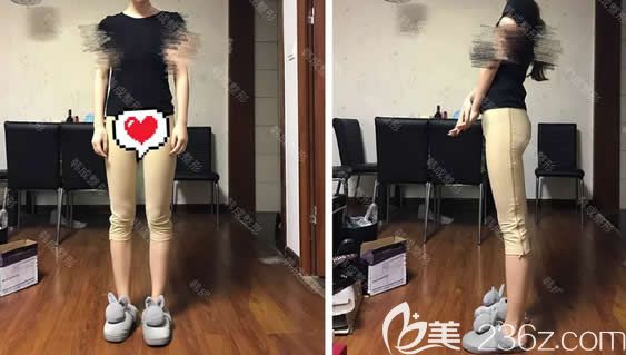 我在南寧韓成整形做大腿環(huán)形吸脂第10天 我在南寧韓成整形做大腿環(huán)形吸脂第10天