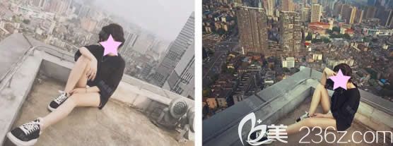 這是我在南寧韓成整形做大腿360環(huán)形吸脂后1-300天恢復(fù)過(guò)程圖，竟然沒(méi)有反彈哦