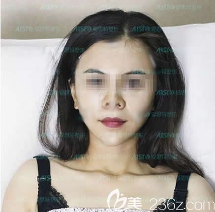 面部填充是脂肪好還是玻尿酸好？圍觀我在南寧愛思特整形做全臉自體脂肪填充第5天消腫照片