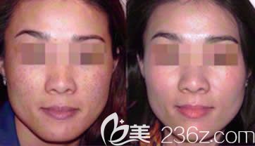 南寧韓成整形韋娉婷主任激光祛斑案例 南寧韓成整形韋娉婷主任激光祛斑案例