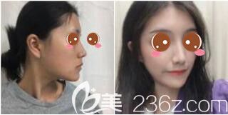 醫(yī)院整形美容科楊苓山鼻綜合真人案例