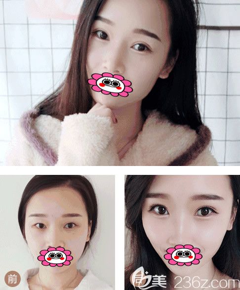 西安畫美整形醫(yī)院雙眼皮效果圖