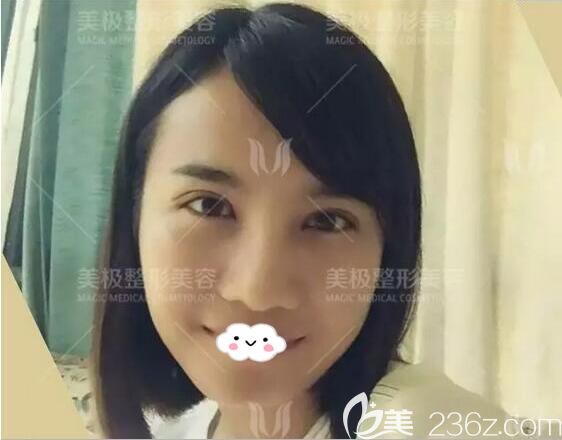 雙眼皮+假體隆鼻術(shù)后15天效果