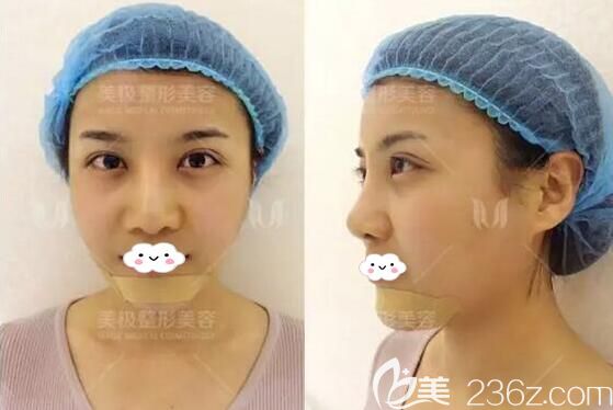成都美極假體墊下巴術(shù)后即刻