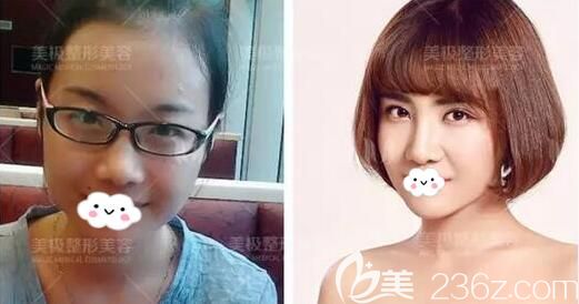 成都美極雙眼皮隆鼻豐下巴術(shù)后對比