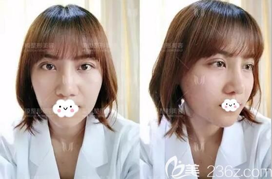 假體隆下巴術(shù)后7天效果