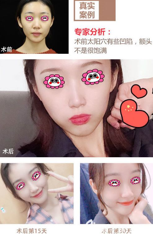 西安畫美面部脂肪填充對比圖