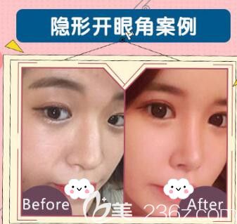 荊州華美李杰雙眼皮+開內(nèi)眼角真人案例
