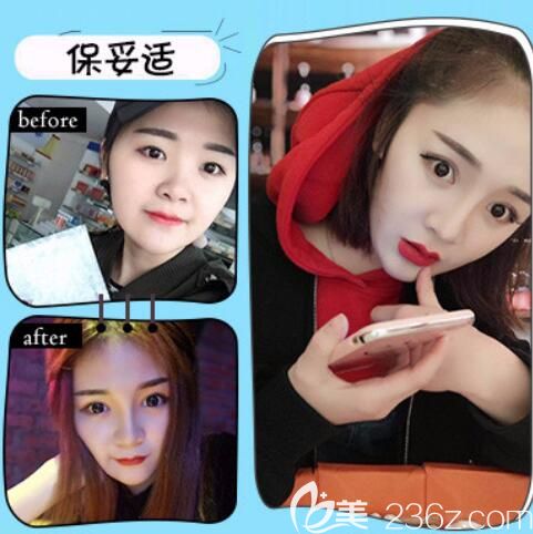 合肥韓美整形注射瘦臉除皺瘦臉瘦臉案例