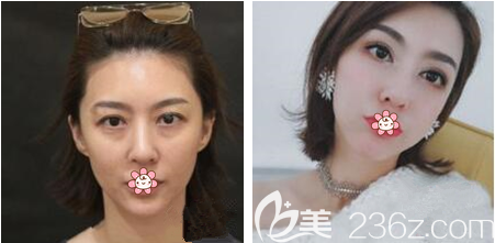 重慶藝星整形王方鵬做雙眼皮怎么樣 重慶藝星整形王方鵬做雙眼皮怎么樣