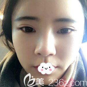 荊州華美割雙眼皮效果怎么樣？<!--<i data=20240703-sp></i>-->眼綜合案例