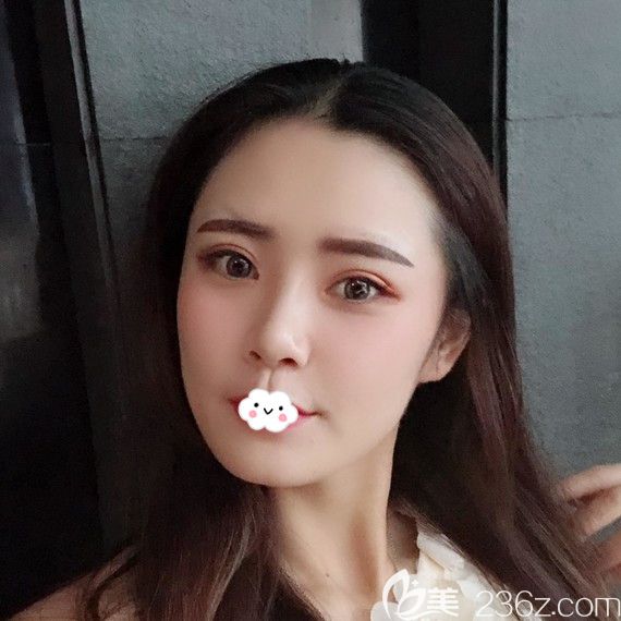 荊州華美<!--<i data=20240703-sp></i>-->雙眼皮案例術(shù)后恢復(fù)效果圖