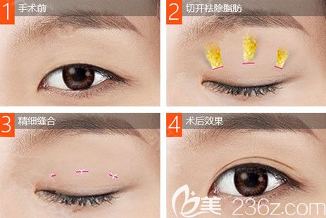 張家港康麗做雙眼皮效果圖