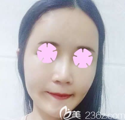 我在南寧夢(mèng)想做全臉自體脂肪填充后第3天 我在南寧夢(mèng)想做全臉自體脂肪填充后第3天