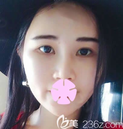 我在南寧夢(mèng)想做自體脂肪填充全臉術(shù)后第15天 我在南寧夢(mèng)想做自體脂肪填充全臉術(shù)后第15天