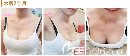 說(shuō)說(shuō)我花8萬(wàn)元找廣州博仕整形醫(yī)院張建軍做完月亮女神隆胸術(shù)后的真實(shí)感受