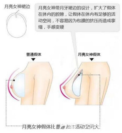 廣州博仕月亮女神隆胸優(yōu)勢