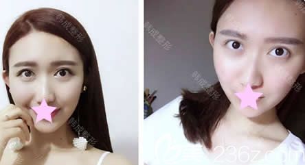 在南寧韓成做全臉線雕提升第7天