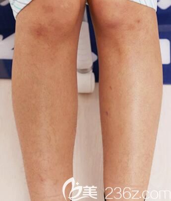 我在南寧華美整形做激光脫毛前的照片 我在南寧華美整形做激光脫毛前的照片