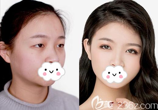 張主任做切開雙眼皮術后105天恢復效果