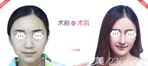 做膨體隆鼻術(shù)后60天的恢復(fù)效果